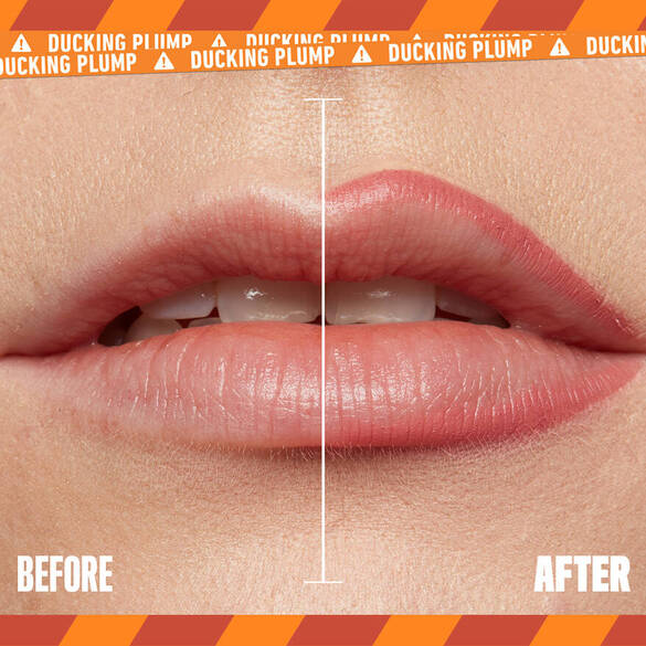 A close-up of lips, labeled \'Before\' on the left and \'After\' on the right, showing enhanced fullness and color.