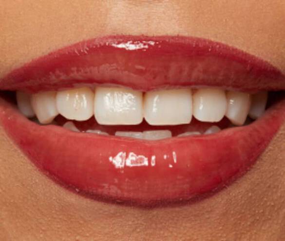 Close-up of a smiling mouth with glossy red lips and bright white teeth against a neutral background.